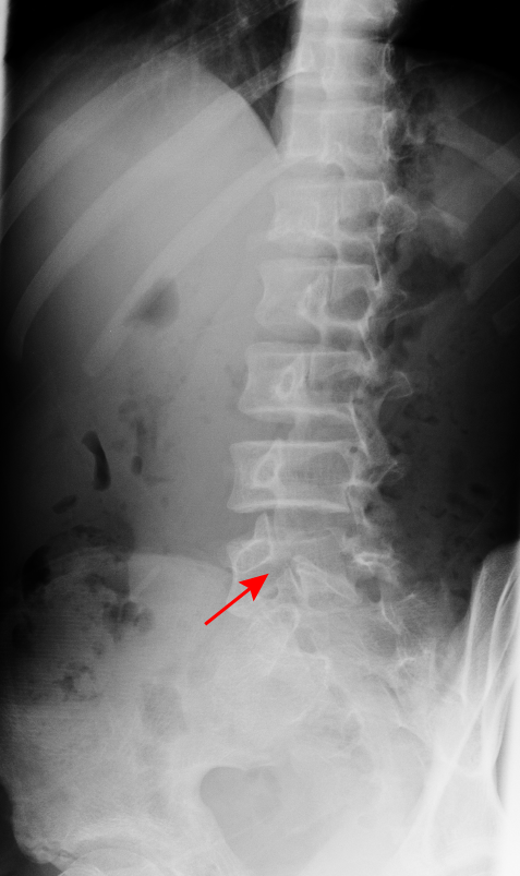 腰椎分離症レントゲン